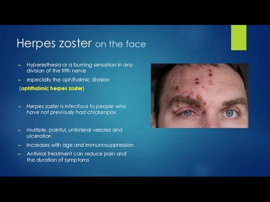 Herpes zoster on the face Hyperesthesia or a burning sensation in any