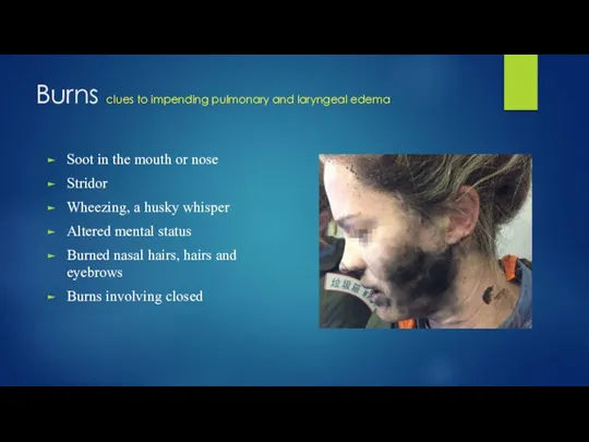 Burns clues to impending pulmonary and laryngeal edema Soot in the mouth