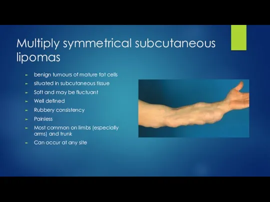 Multiply symmetrical subcutaneous lipomas benign tumours of mature fat cells situated in