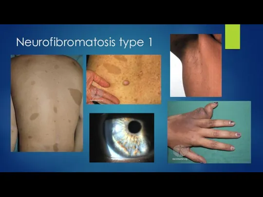 Neurofibromatosis type 1