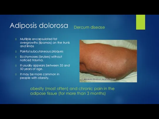 Adiposis dolorosa obesity (most often) and chronic pain in the adipose tissue