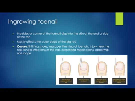 Ingrowing toenail the sides or corner of the toenail digs into the