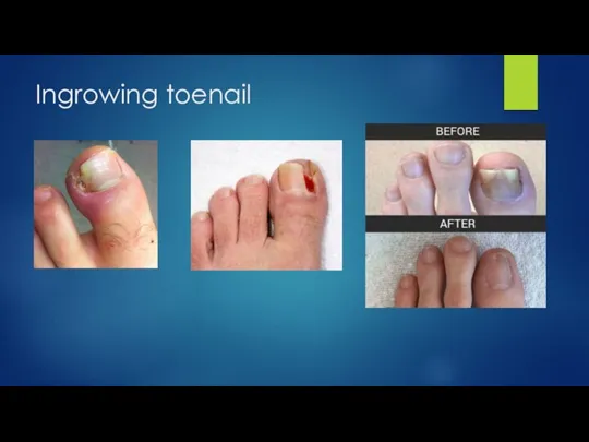 Ingrowing toenail