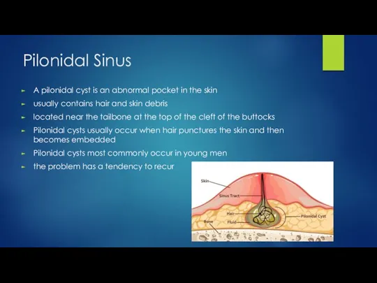 Pilonidal Sinus A pilonidal cyst is an abnormal pocket in the skin