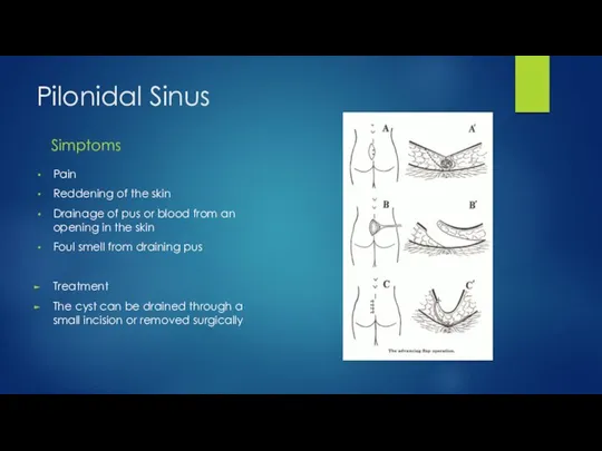 Pilonidal Sinus Simptoms Pain Reddening of the skin Drainage of pus or