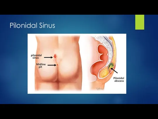 Pilonidal Sinus