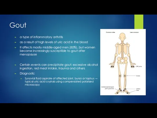 Gout a type of inflammatory arthritis as a result of high levels