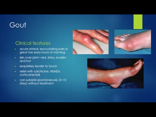 Gout Clinical features acute attack: excruciating pain in great toe early hours