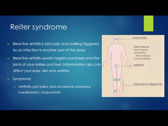 Reiter syndrome Reactive arthritis is joint pain and swelling triggered by an