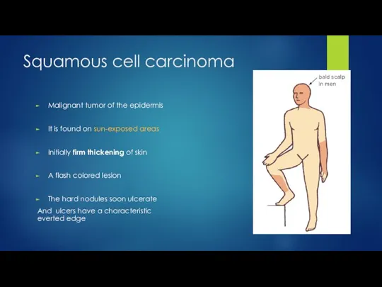 Squamous cell carcinoma Malignant tumor of the epidermis It is found on