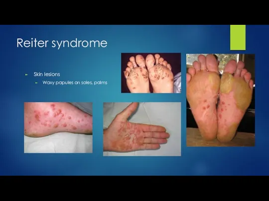 Reiter syndrome Skin lesions Waxy papules on soles, palms