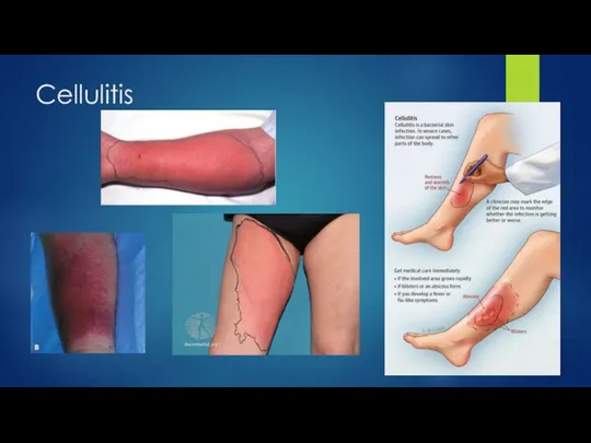 Cellulitis