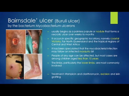 Bairnsdale’ ulcer (Buruli ulcer) by the bacterium Mycobacterium ulcerans usually begins as