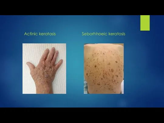 Actinic keratosis Seborhhoeic keratosis