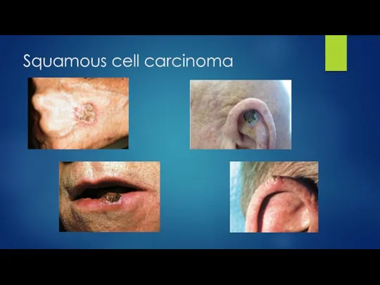 Squamous cell carcinoma