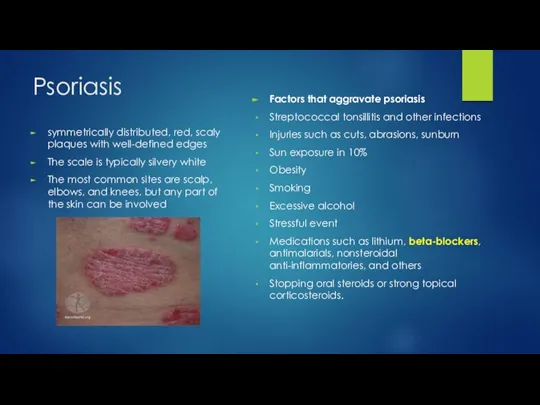 Psoriasis symmetrically distributed, red, scaly plaques with well-defined edges The scale is