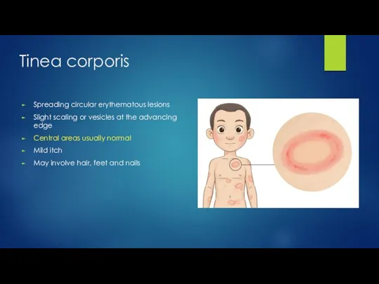 Tinea corporis Spreading circular erythematous lesions Slight scaling or vesicles at the