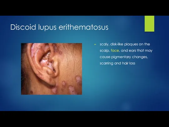 Discoid lupus erithematosus scaly, disk-like plaques on the scalp, face, and ears