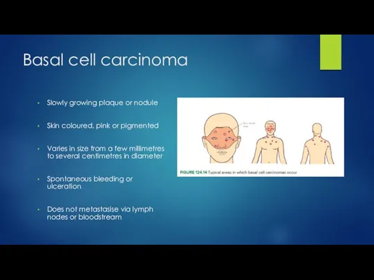 Basal cell carcinoma Slowly growing plaque or nodule Skin coloured, pink or