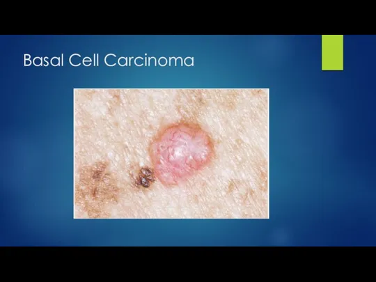 Basal Cell Carcinoma