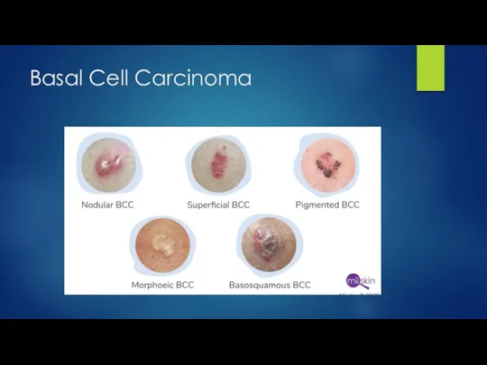 Basal Cell Carcinoma