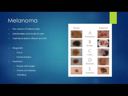 Melanoma The cancer of melanocytes Metastasizes and locally invade A jet-black lesions