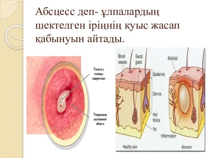 Абсцесс деп- ұлпалардың шектелген іріңнің қуыс жасап қабынуын айтады.