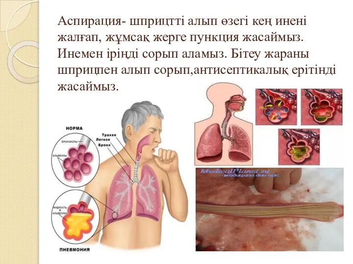 Аспирация- шприцтті алып өзегі кең инені жалғап, жұмсақ жерге пункция жасаймыз. Инемен