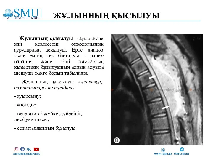 ЖҰЛЫННЫҢ ҚЫСЫЛУЫ semeymedicaluniversity SSMUofficial www.ssmu.kz Жұлынның қысылуы – ауыр және жиі кездесетін