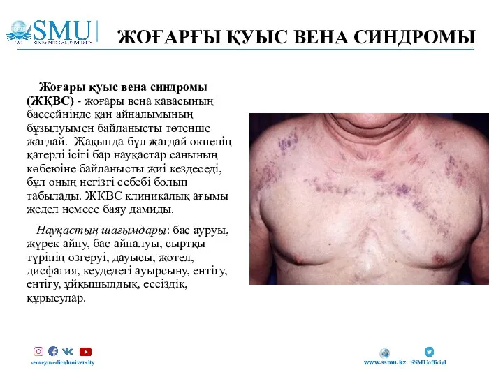 ЖОҒАРҒЫ ҚУЫС ВЕНА СИНДРОМЫ semeymedicaluniversity SSMUofficial www.ssmu.kz Жоғары қуыс вена синдромы (ЖҚВС)