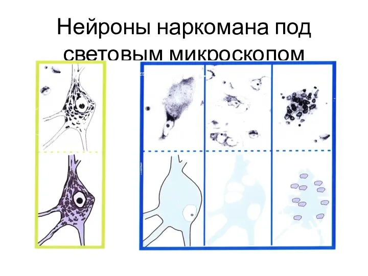 Нейроны наркомана под световым микроскопом