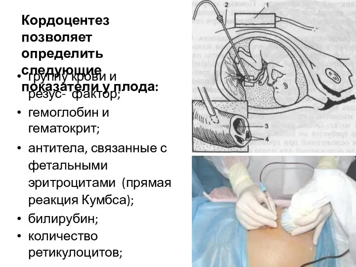 Кордоцентез позволяет определить следующие показатели у плода: группу крови и резус- фактор;