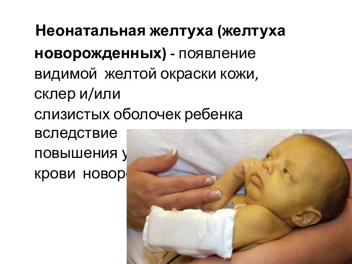 Неонатальная желтуха (желтуха новорожденных) - появление видимой желтой окраски кожи, склер и/или