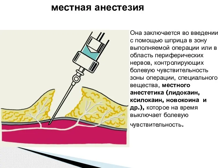 Она заключается во введении с помощью шприца в зону выполняемой операции или