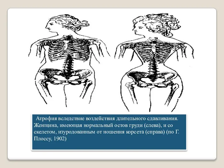 Атрофия вследствие воздействия длительного сдавливания. Женщина, имеющая нормальный остов груди (слева), и