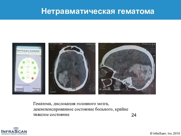 Нетравматическая гематома Гематома, дислокация головного мозга, декомпенсированное состояние больного, крайне тяжелое состояние