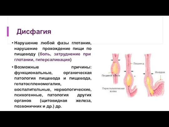 Дисфагия Нарушение любой фазы глотания, нарушение прохождение пищи по пищеводу (боль, затруднение