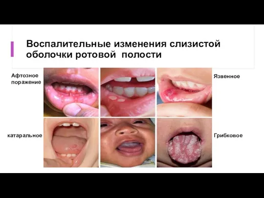 Воспалительные изменения слизистой оболочки ротовой полости Афтозное поражение Язвенное катаральное Грибковое