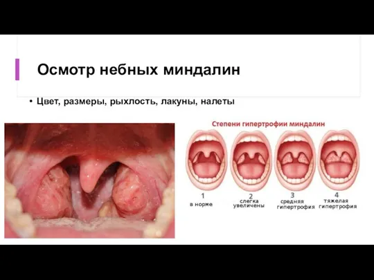 Осмотр небных миндалин Цвет, размеры, рыхлость, лакуны, налеты