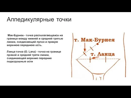 Мак-Бурнея - точка располагающаяся на границе между нижней и средней третью линии,