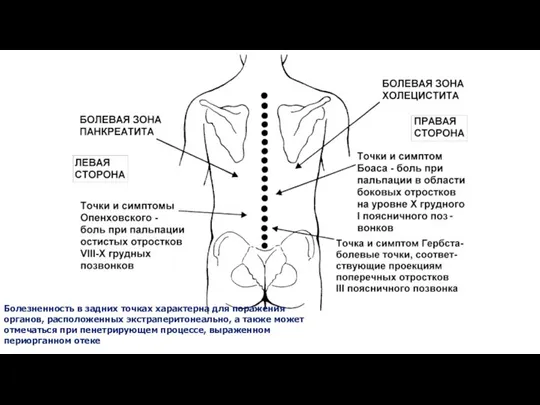 Болезненность в задних точках характерна для поражения органов, расположенных экстраперитонеально, а также