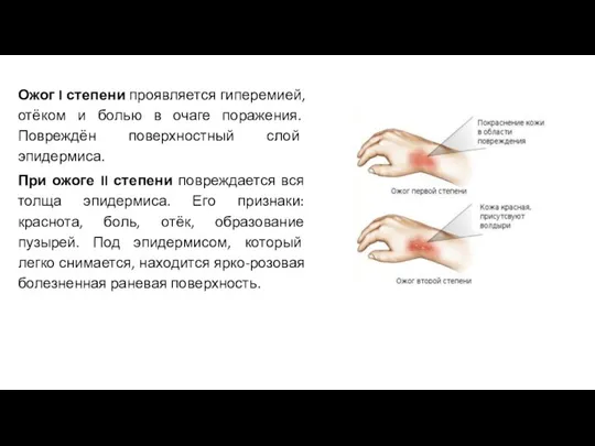 Ожог I степени проявляется гиперемией, отёком и болью в очаге поражения. Повреждён