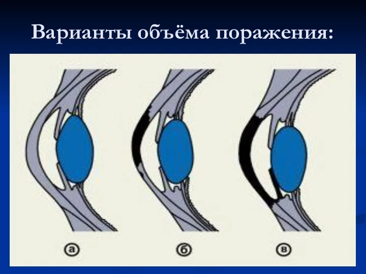 Варианты объёма поражения: