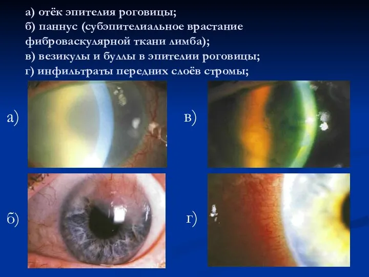а) отёк эпителия роговицы; б) паннус (субэпителиальное врастание фиброваскулярной ткани лимба); в)