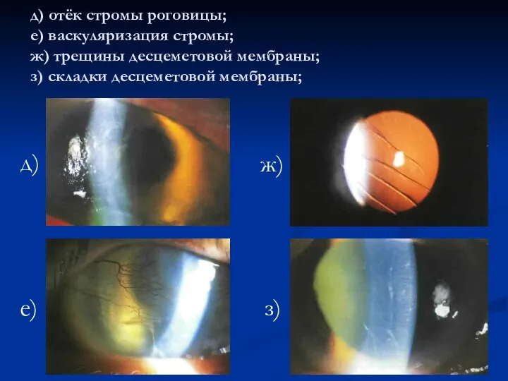 д) отёк стромы роговицы; е) васкуляризация стромы; ж) трещины десцеметовой мембраны; з)