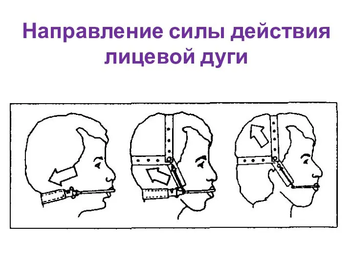 Направление силы действия лицевой дуги