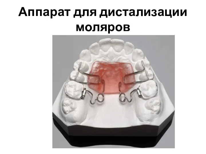 Аппарат для дистализации моляров