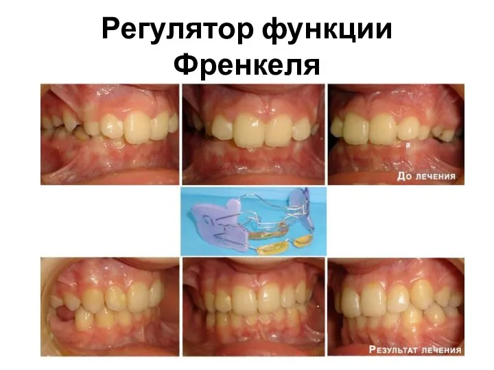 Регулятор функции Френкеля