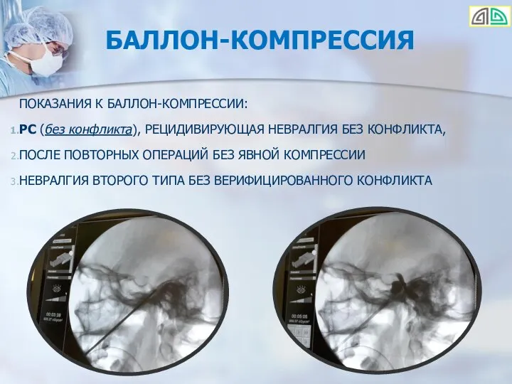 БАЛЛОН-КОМПРЕССИЯ ПОКАЗАНИЯ К БАЛЛОН-КОМПРЕССИИ: РС (без конфликта), РЕЦИДИВИРУЮЩАЯ НЕВРАЛГИЯ БЕЗ КОНФЛИКТА, ПОСЛЕ