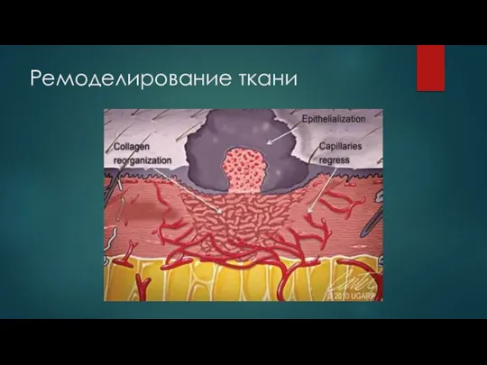 Ремоделирование ткани